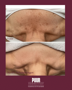 pigmentvlekken decollete huidtherapeut ipl puur huidinstituut laserkliniek brabant