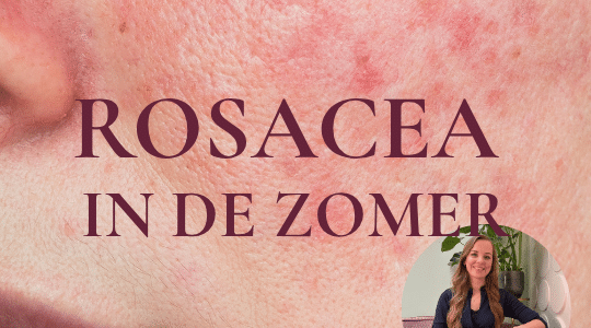 Rosacea in de zomer beauty blog huidtherapeut PUUR Hudinstituut