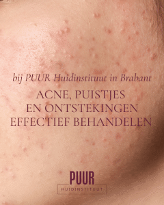 Acne, puistjes en ontstekingen effectief behandelen bij PUUR Huidinstituut in Brabant: Breda Prinsenbeek Oosterhout