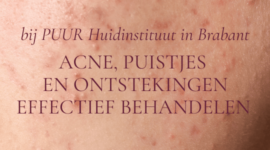 Acne, puistjes en ontstekingen effectief behandelen bij PUUR Huidinstituut in Brabant: Breda Prinsenbeek Oosterhout
