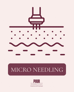 Micro needling bij PUUR Huidinstituut Brabant Breda-Prinsenbeek en Oosterhout
